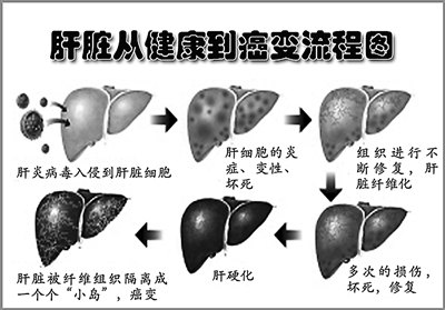 《解放军报》:第二军医大学最新成果为肝癌病人送去福音